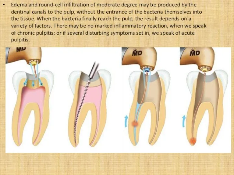Edema and round-cell infiltration of moderate degree may be produced by the dentinal
