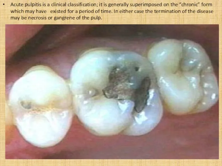 Acute pulpitis is a clinical classification; it is generally superimposed on the “chronic”