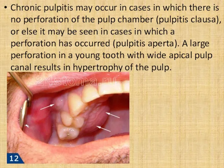 Chronic pulpitis may occur in cases in which there is no perforation of