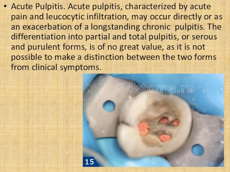 Acute Pulpitis. Acute pulpitis, characterized by acute pain and leucocytic infiltration, may occur