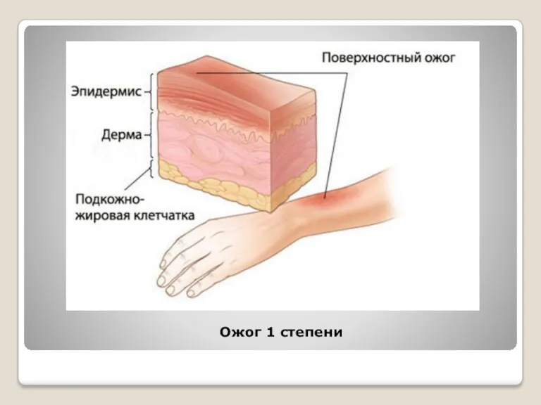 Ожог 1 степени