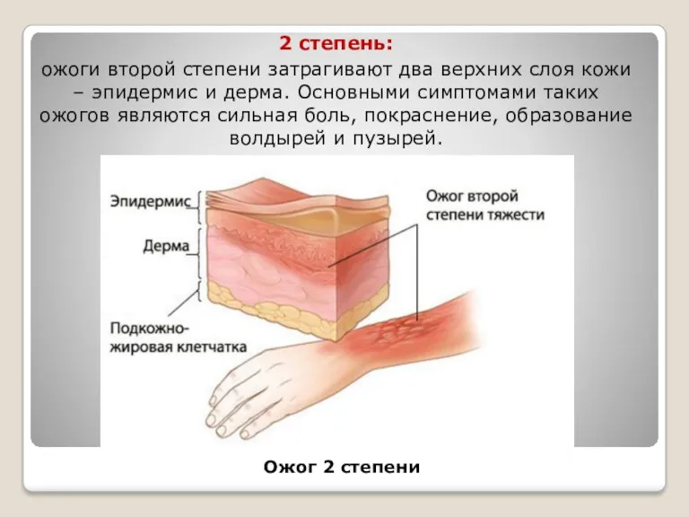 2 степень: ожоги второй степени затрагивают два верхних слоя кожи