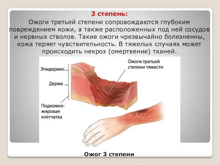 3 степень: Ожоги третьей степени сопровождаются глубоким повреждением кожи, а