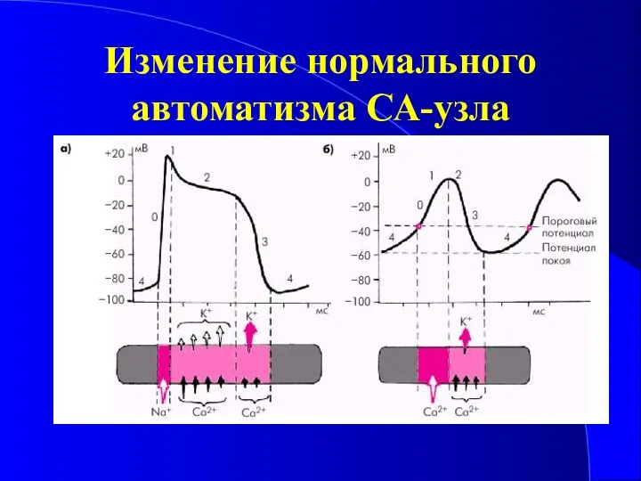 Изменение нормального автоматизма СА-узла