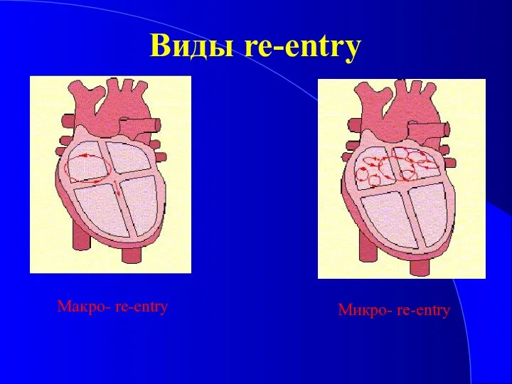 Виды re-entry Макро- re-entry Микро- re-entry