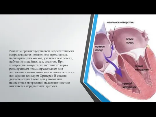 Развитие правожелудочковой недостаточности сопровождается появлением акроцианоза, периферических отеков, увеличением печени,