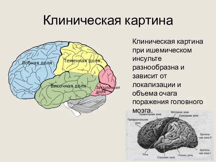 Клиническая картина Клиническая картина при ишемическом инсульте разнообразна и зависит