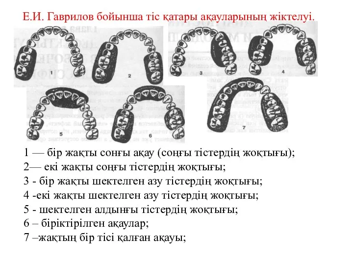 Е.И. Гаврилов бойынша тіс қатары ақауларының жіктелуі. 1 — бір жақты сонғы ақау