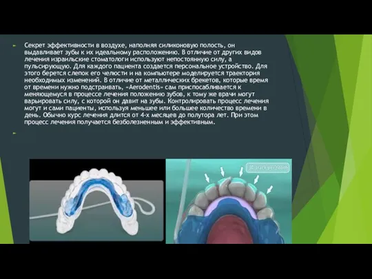 Секрет эффективности в воздухе, наполняя силиконовую полость, он выдавливает зубы