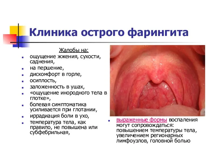 Клиника острого фарингита Жалобы на: ощущение жжения, сухости, саднения, на