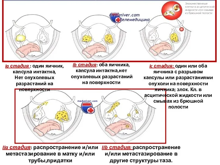 Ia стадия : один яичник,капсула интактна, Нет опухолевых разрастаний на