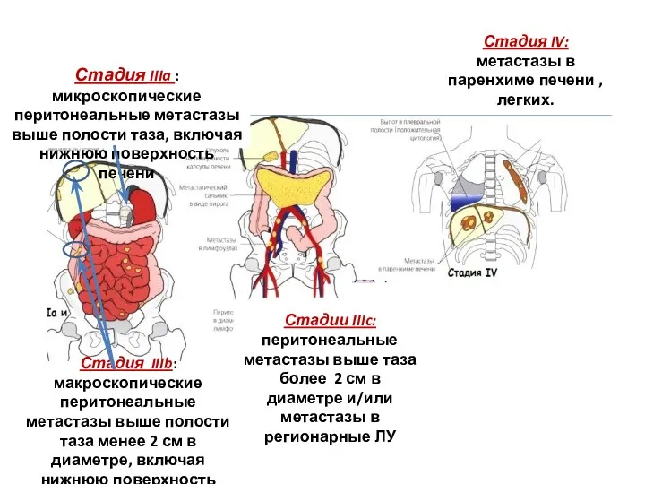 Стадия IIIa : микроскопические перитонеальные метастазы выше полости таза, включая