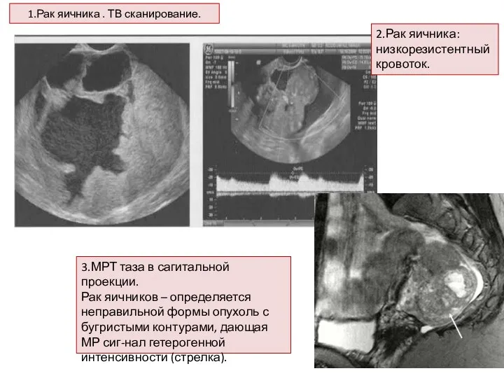 1.Рак яичника . ТВ сканирование. 2.Рак яичника: низкорезистентный кровоток. 3.МРТ