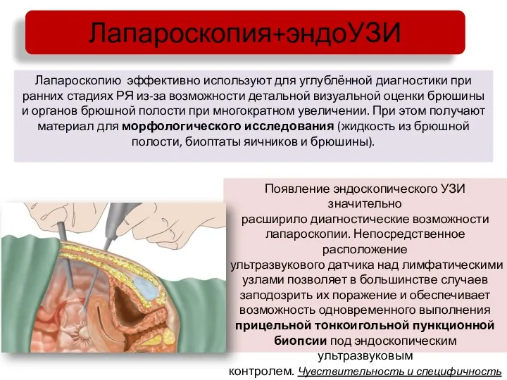 Лапароскопия+эндоУЗИ Лапароскопию эффективно используют для углублённой диагностики при ранних стадиях