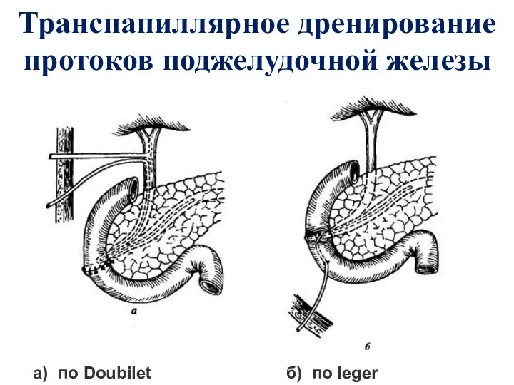 Транспапиллярное дренирование протоков поджелудочной железы а) по Doubilet б) по leger