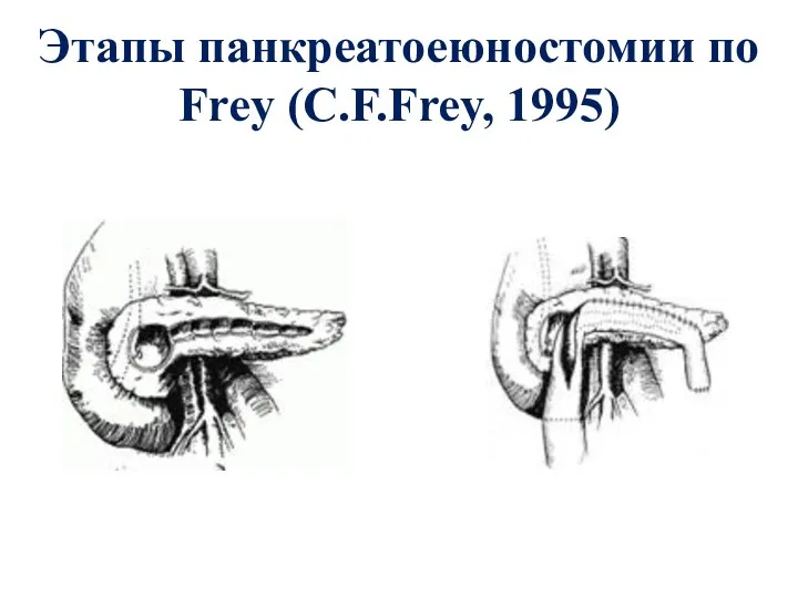 Этапы панкреатоеюностомии по Frey (C.F.Frey, 1995)