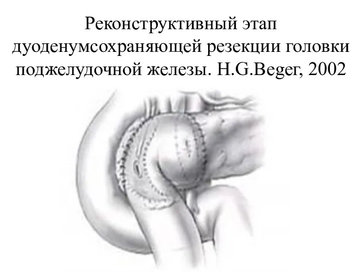 Реконструктивный этап дуоденумсохраняющей резекции головки поджелудочной железы. H.G.Веgег, 2002