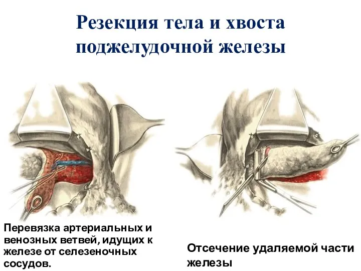 Резекция тела и хвоста поджелудочной железы Перевязка артериальных и венозных ветвей, идущих к