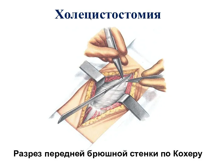 Холецистостомия Разрез передней брюшной стенки по Кохеру