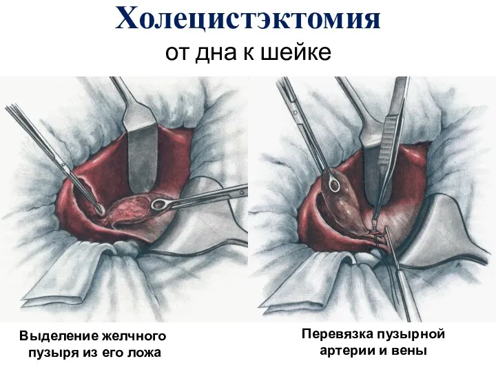 Холецистэктомия от дна к шейке Выделение желчного пузыря из его ложа Перевязка пузырной артерии и вены