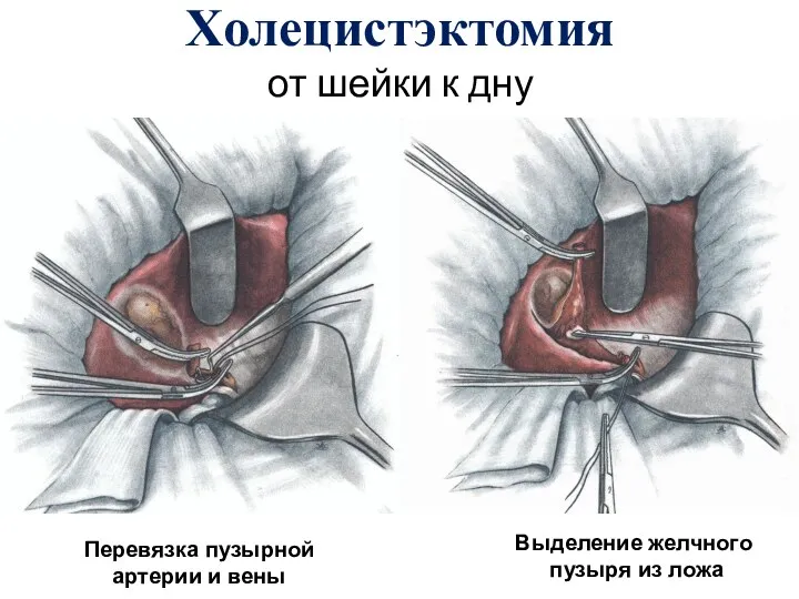 Холецистэктомия от шейки к дну Перевязка пузырной артерии и вены Выделение желчного пузыря из ложа
