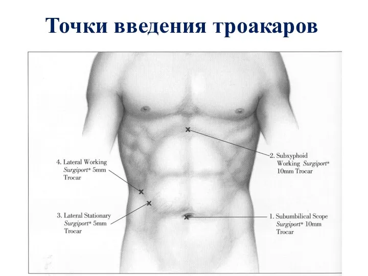 Точки введения троакаров