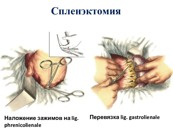 Спленэктомия Наложение зажимов на lig. phrenicolienale Перевязка lig. gastrolienale