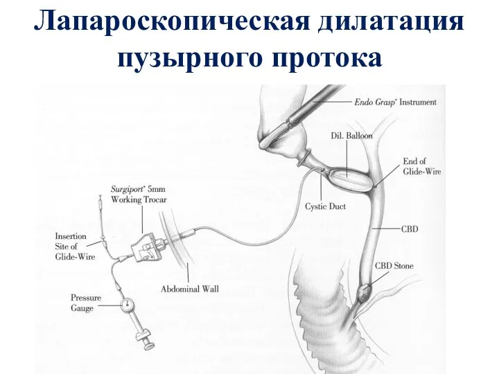 Лапароскопическая дилатация пузырного протока