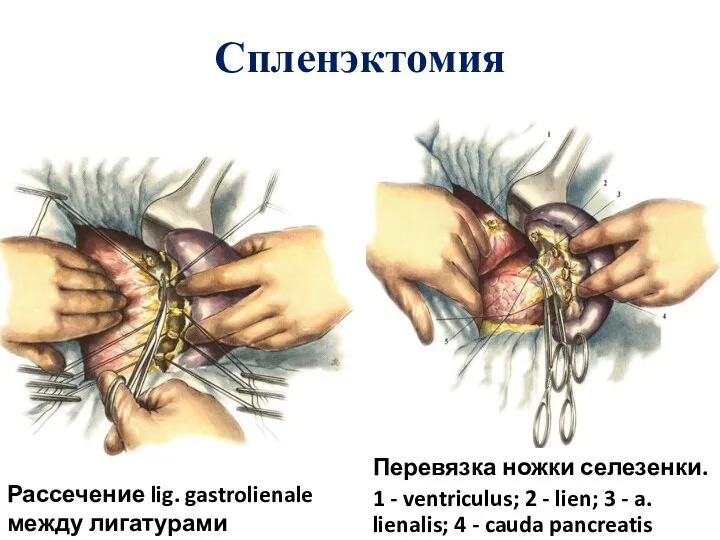 Спленэктомия Рассечение lig. gastrolienale между лигатурами Перевязка ножки селезенки. 1