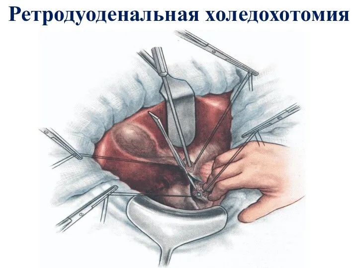 Ретродуоденальная холедохотомия