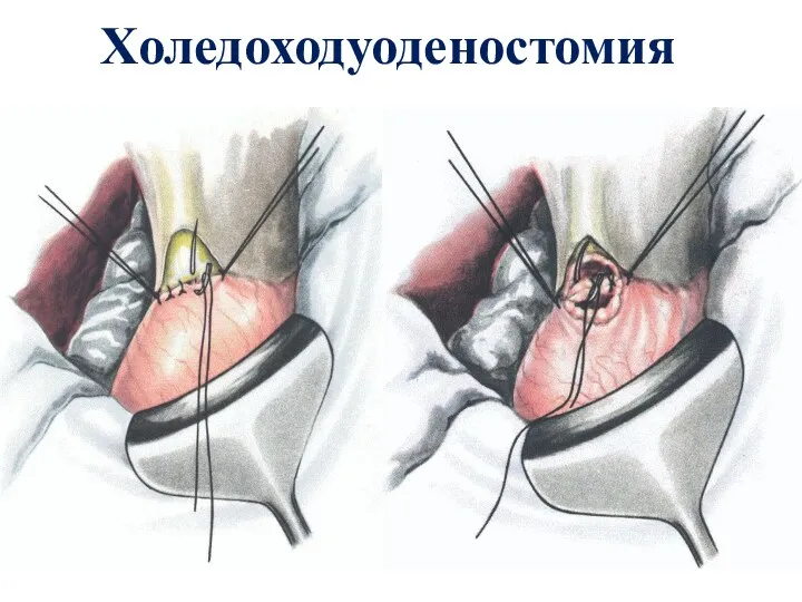 Холедоходуоденостомия