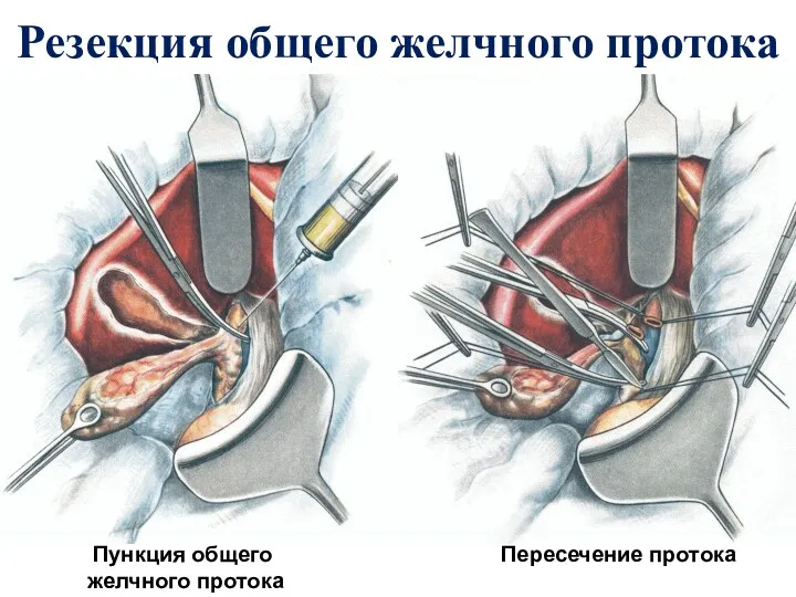 Резекция общего желчного протока Пункция общего желчного протока Пересечение протока