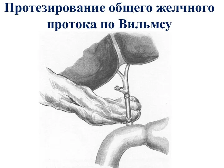 Протезирование общего желчного протока по Вильмсу