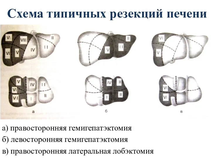 Схема типичных резекций печени а) правосторонняя гемигепатэктомия б) левосторонняя гемигепатэктомия в) правосторонняя латеральная лобэктомия