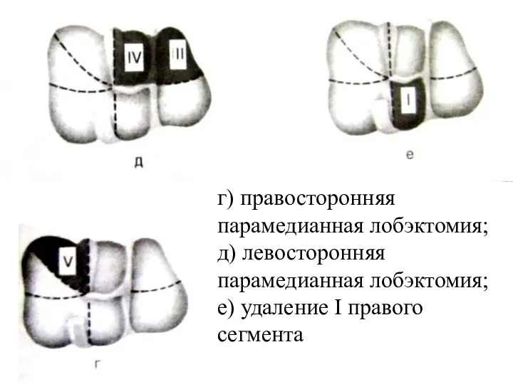 г) правосторонняя парамедианная лобэктомия; д) левосторонняя парамедианная лобэктомия; е) удаление I правого сегмента