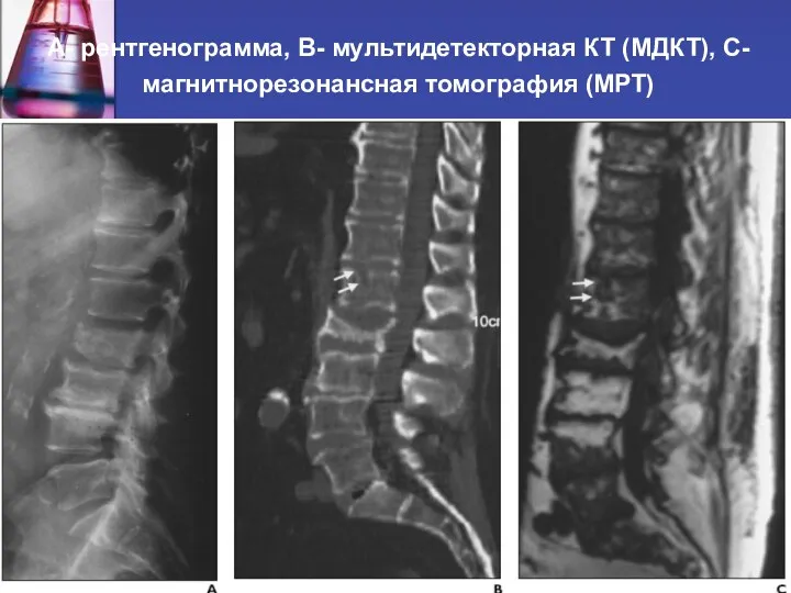 А- рентгенограмма, В- мультидетекторная КТ (МДКТ), С- магнитнорезонансная томография (МРТ)
