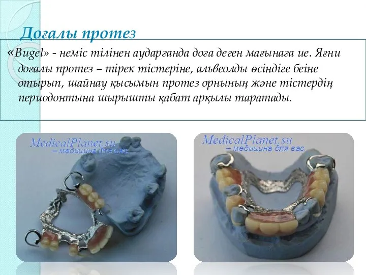 Доғалы протез «Bugel» - неміс тілінен аударғанда доға деген мағынаға