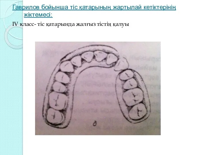 Гаврилов бойынша тіс қатарының жартылай кетіктерінің жіктемесі: IV класс- тіс қатарында жалғыз тістің қалуы