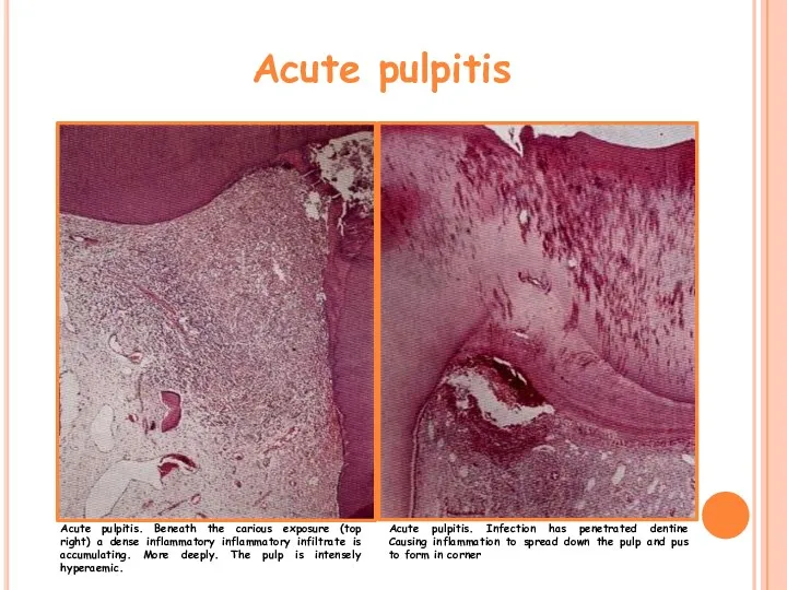 Acute pulpitis Acute pulpitis. Beneath the carious exposure (top right)