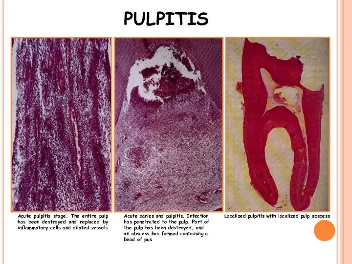 Acute pulpitis stage. The entire pulp has been destroyed and replaced by inflammatory