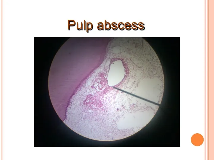 Pulp abscess