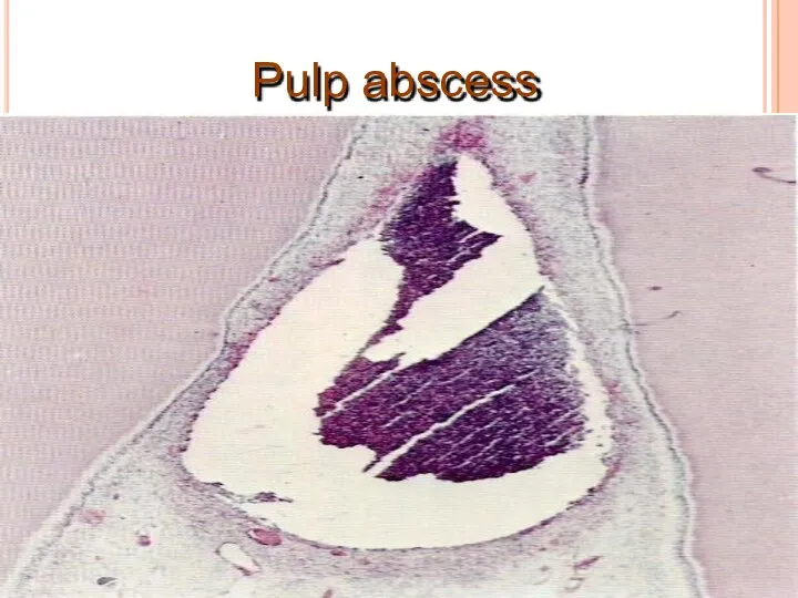 Pulp abscess