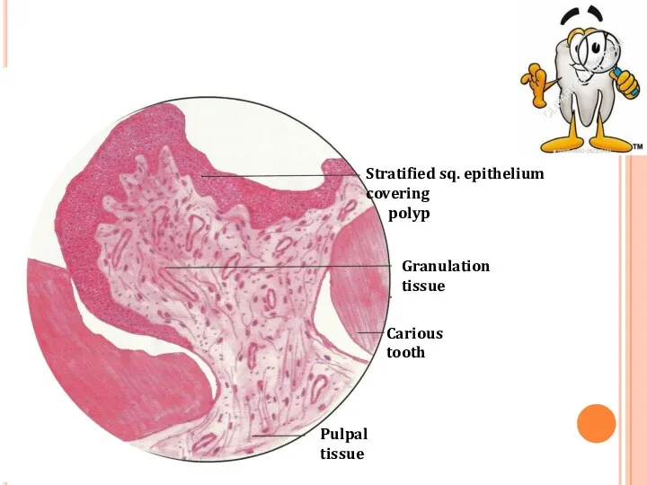Pulpal tissue Stratified sq. epithelium covering polyp Granulation tissue Carious tooth