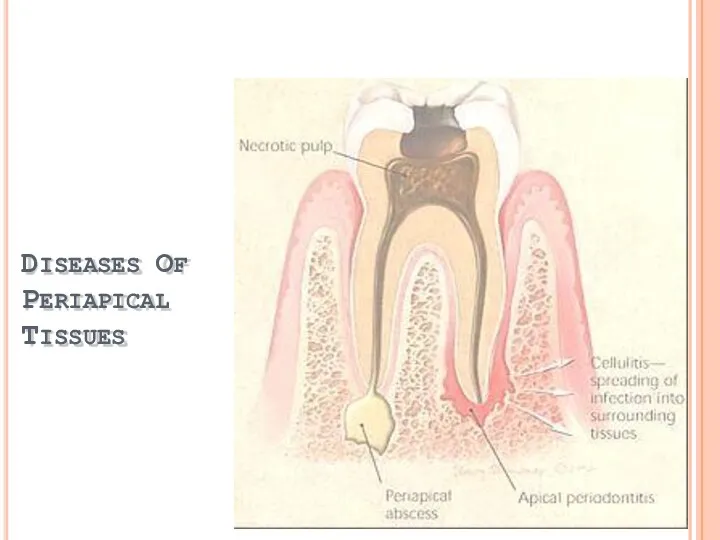DISEASES OF PERIAPICAL TISSUES