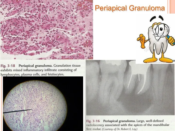 Periapical Granuloma