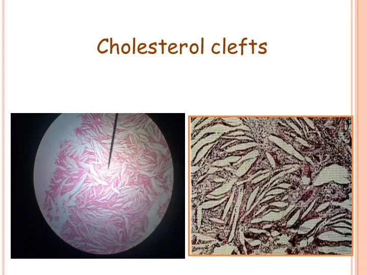 Cholesterol clefts