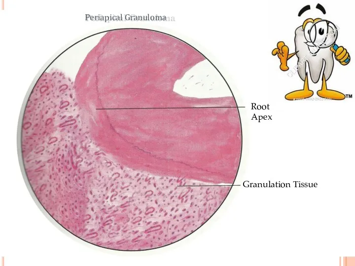 Root Apex Granulation Tissue Periapical Granuloma