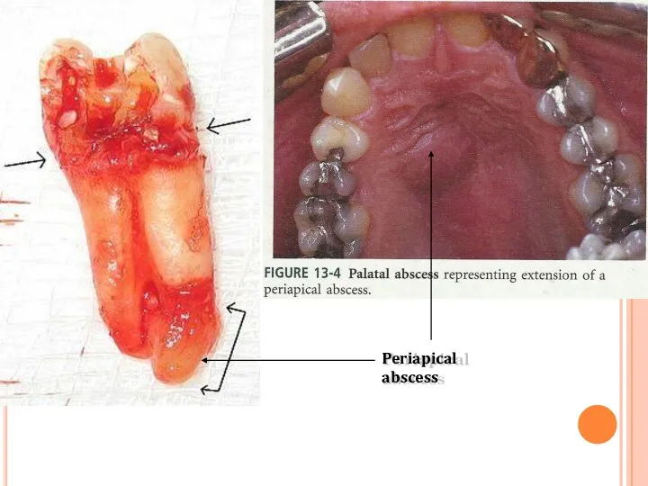 Periapical abscess
