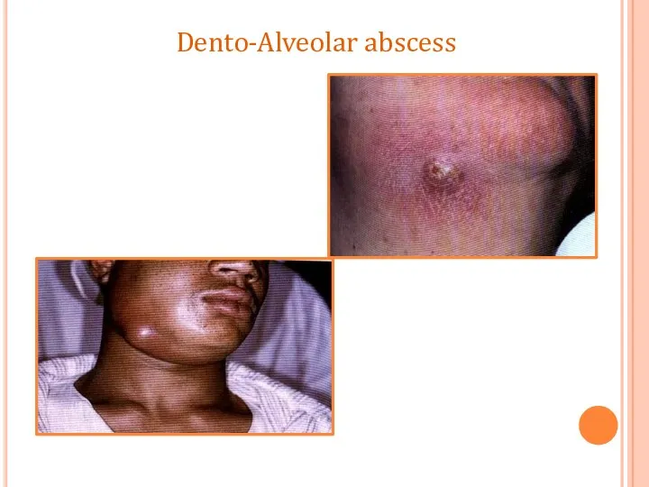 Dento-Alveolar abscess