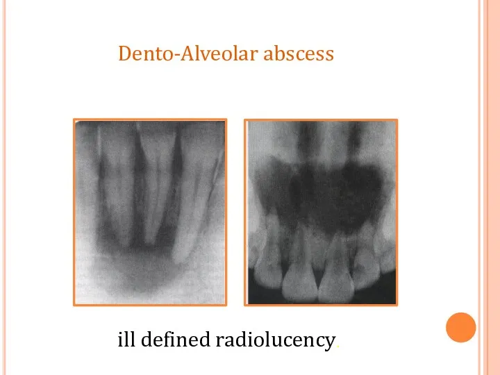 ill defined radiolucency. Dento-Alveolar abscess